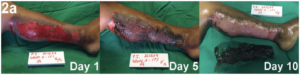 巴西醫療團隊使用鯛魚魚皮作為嚴重傷燙傷敷料，有效保濕、促進傷口修護、消炎止痛，幾乎沒有產生疤痕